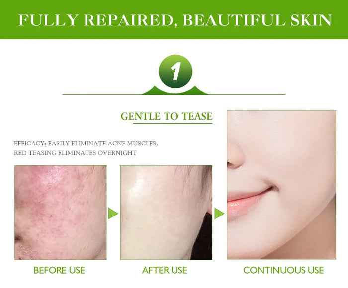 Aichun Beauty Acne Cream 30ml - Effective Pimple Remover and Acne Treatment for Clear Skin