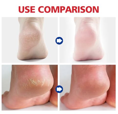 Aichun Beauty Moisturizing Foot Cream for Cracked Heels, Dead Skin Care Removal Cream, 20G - MAT Beauty