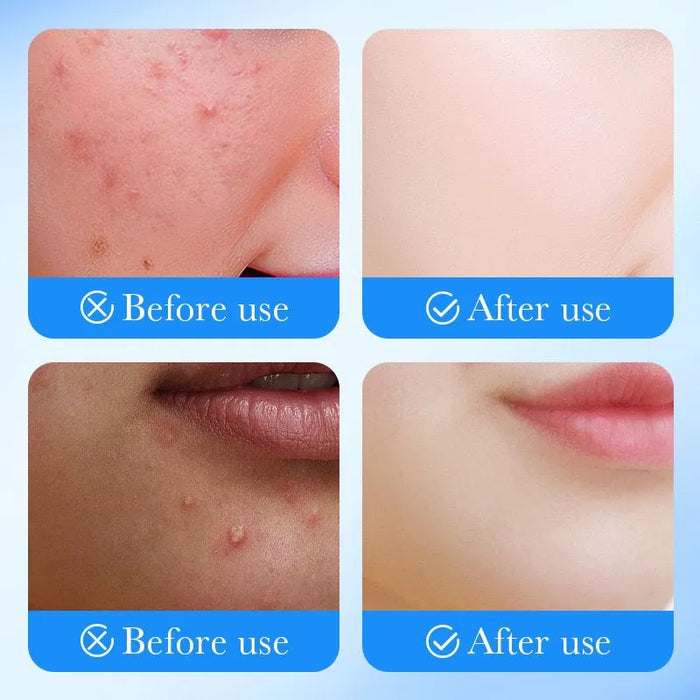 Sadoer Salicylic Acid Acne Patch for Invisible Pimple Repair and Clearer Skin - MAT Beauty