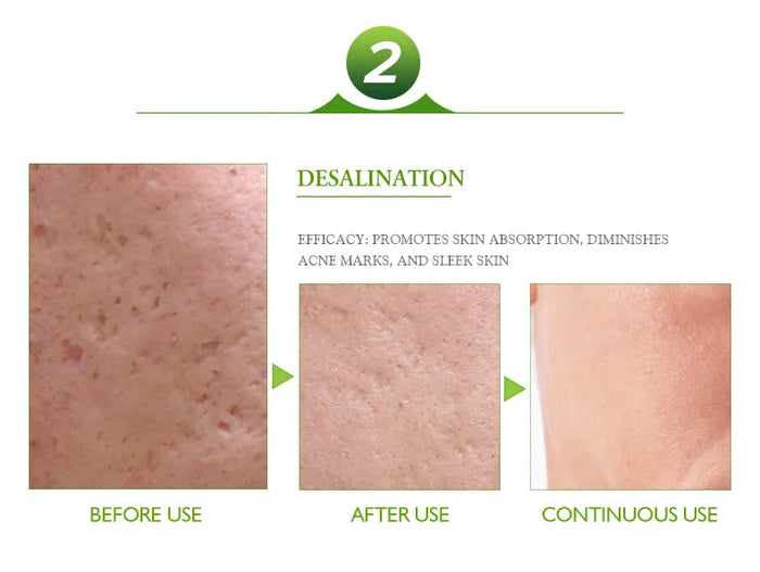 Aichun Beauty Acne Cream 30ml - Effective Pimple Remover and Acne Treatment for Clear Skin - MAT Beauty