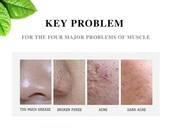 Aichun Beauty Acne Cream 30ml - Effective Pimple Remover and Acne Treatment for Clear Skin - MAT Beauty