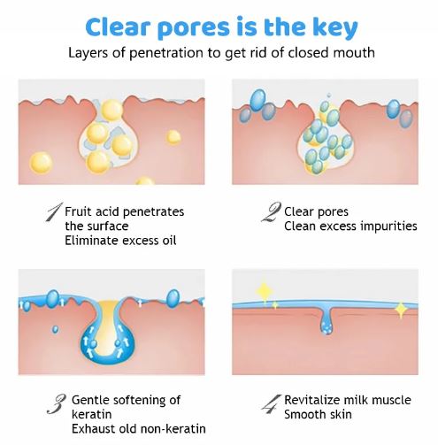 AICHUN BEAUTY Salicylic Acid Face Serum for Purifying, Shrink Pores, Exfoliation, Anti-Acne Skin Care 30ml - MAT Beauty