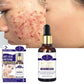 Aichun Beauty Scar Removal Serum - 30ML Glowing Remover for Scars - MAT Beauty