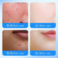 Sadoer Salicylic Acid Acne Patch for Invisible Pimple Repair and Clearer Skin - MAT Beauty